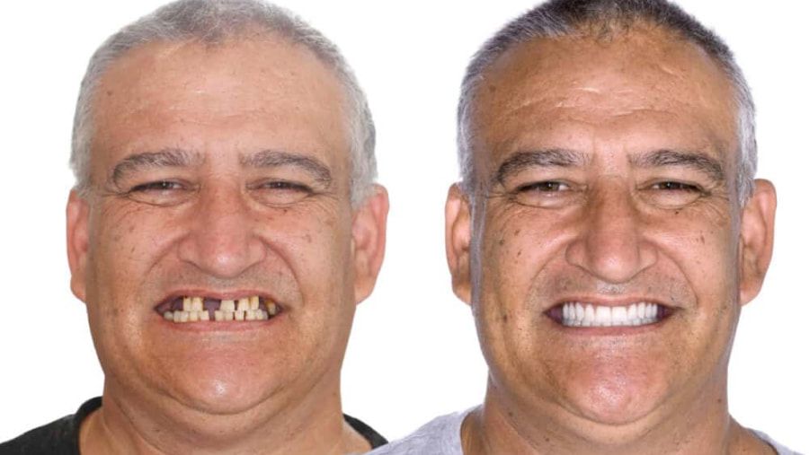 Elder People Can Now Have Their Teeth Substituted For Free