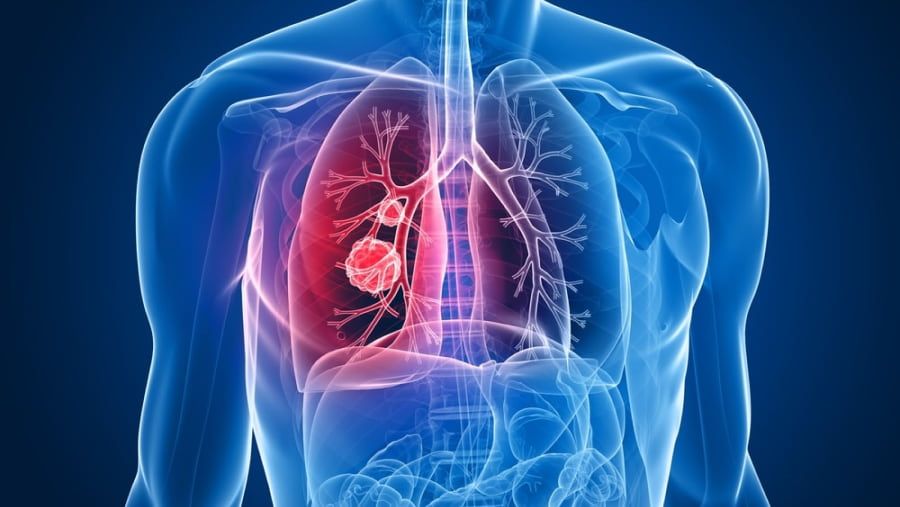 How to Choose the Treatment of Lung Cancer